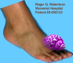 Foot that developed a shell
