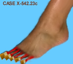 A case of "brush toes"